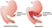 остър симптоми