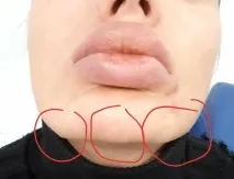 назолакрималната бразда Онлайн консултация
