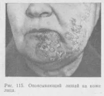 стоматология херпес