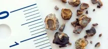 Пісок у сечі та сечовому міхурі симптоми та лікування у чоловіків та жінок міхурі