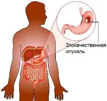 Остання стадія раку симптоми та опис стадія