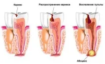 предотвратяване предотвратяване