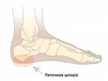 П’яткова шпора – методи лікування, діагностика, симптоми, препарати, профілактика – портал лікування