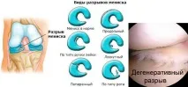 суглоба