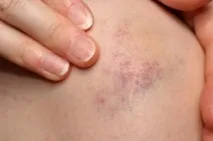 синини склеротерапия