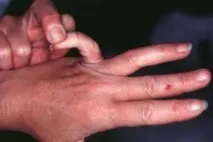 синдром симптоми