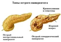 атака панкреатична