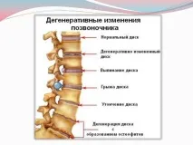 спондилозата лумбосакралния