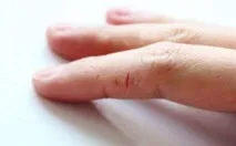 Тріщини на руках лікування народними засобами в домашніх умовах мазі, крему, засоби та інші народними