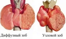 симптоми щитовидната
