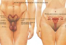 стерилизация хирургичната