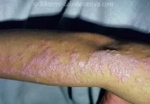 трихофития лечение