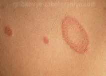 лечение стартирани