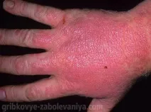 лечение стартирани