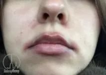 махмурлук против