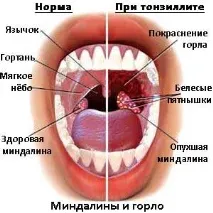 тонзилит тонзилит