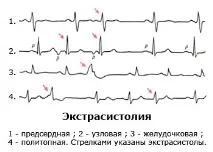 Болі в серці при остеохондрозі причини та лікування серці