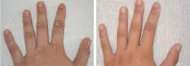 брадавиците брадавиците
