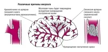 инсулт какво