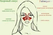 гаймориту
