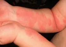 лечение снимка