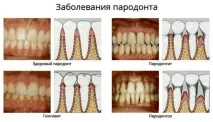 неприятна миризма халитоза