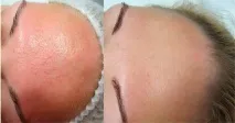 гликолен лице