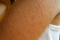 кожната хиперкератоза