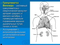 Гранулематоз Вегенера (гранулематозний васкуліт) - причини, симптоми, лікування, діагностика, фото вегенера