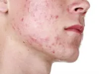 enterosgel enterosgel