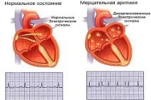 мъждене ритъма