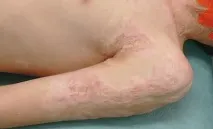 кинезиотейпинг кинезиотейпинг