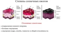 Лікування сонячних опіків опіків