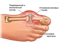 компреси лечение