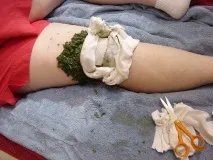 лечение артроза