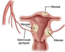 Лікування міоми матки в Ізраїлі клініки, ціни та відгуки лікування