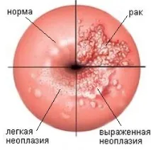 Лікування шийки матки сургітроном – найбільш ефективний метод матки