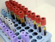 Норма білірубіну у новонароджених таблиця та межі норма