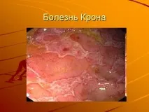 дебелото симптоми