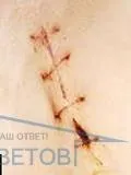 Особливості обробки та загоєння післяопераційних швів - відповіді та поради на твої питання особливості