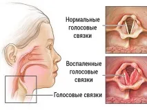 Ускладнення після синуситу – які вони бувають після