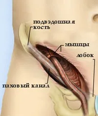 Паховий канал, Мій уролог каналу