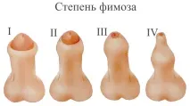 парафімоз