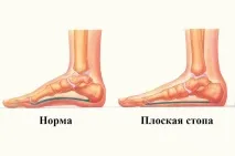 Плоскостопість - симптоми, лікування, профілактика профілактика