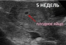 Чому УЗД не показує вагітність випадки при затримці місячних та на ранніх термінах чому