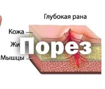 Поріз види, типи порізів поріз