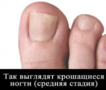 За якими ознаками можна зрозуміти, що організму не вистачає вітамінів можна