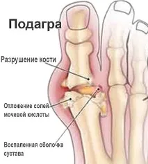 пристъп подагра снимка