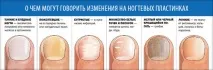 За якими ознаками можна зрозуміти, що організму не вистачає вітамінів якими