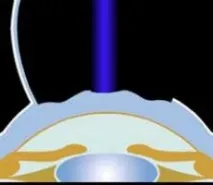 PresbyLASIK (ПресбіЛасік) Операція, відгуки, клініки, ціни відгуки